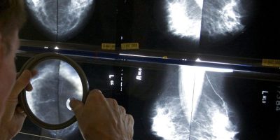 Mammograms - CP