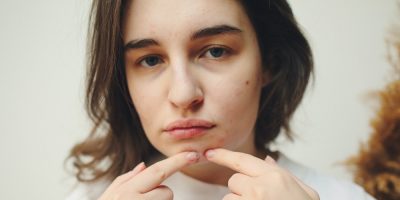 FACE PIMPLES VIA pexels-polina-tankilevitch